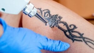 Removal Tattoo, Tattoo remover machine