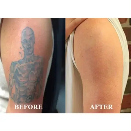 Natural Tattoo Removal